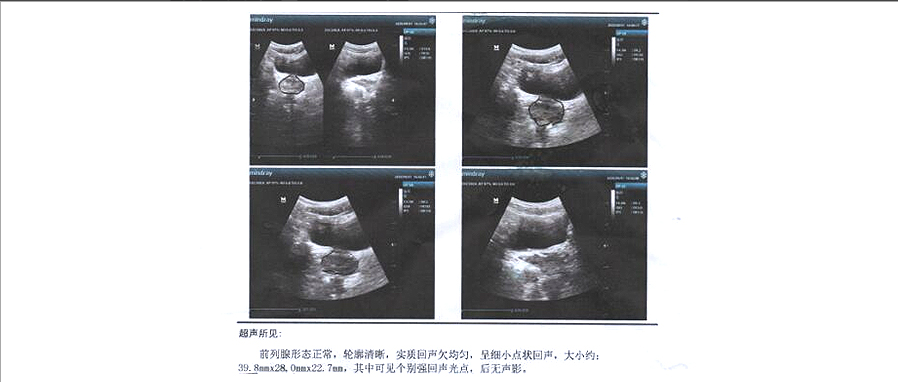 他的前列腺炎伴钙化病情复杂,做手术也没改善(图2) 他的前列腺炎伴钙化病情复杂,做手术也没改善(图2)